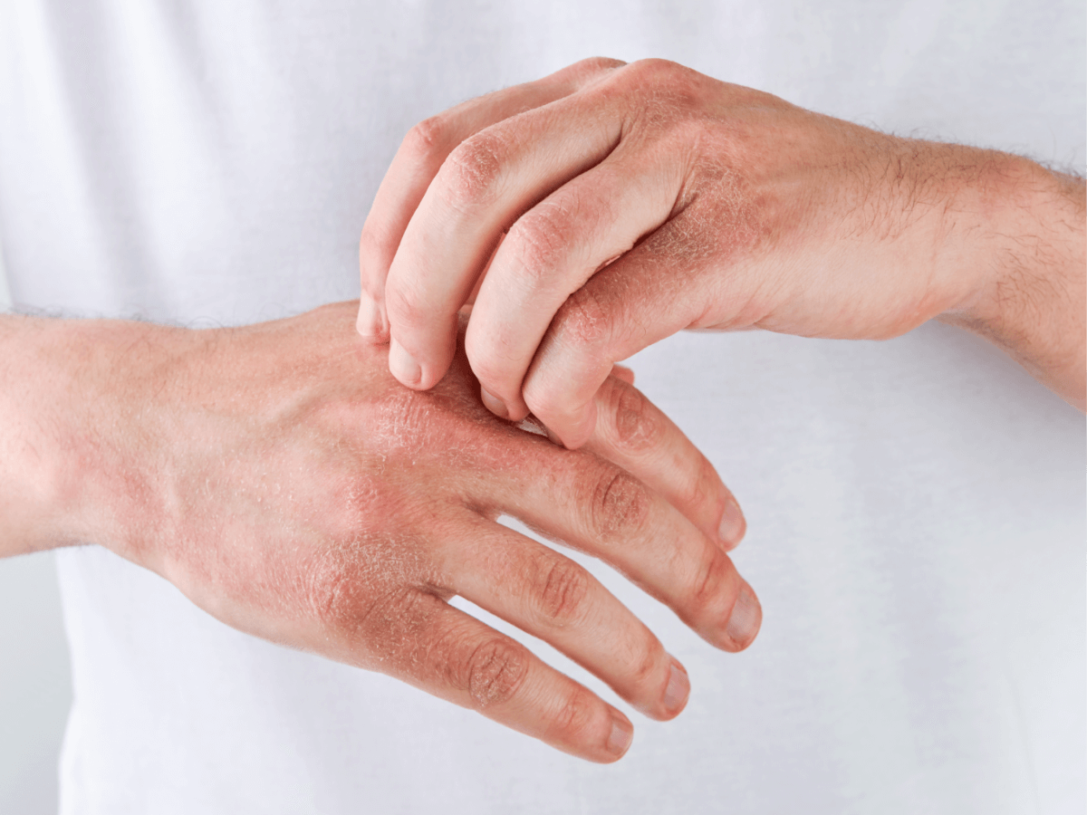 Quand la barrière cutanée <b>s’affaiblit</b> 