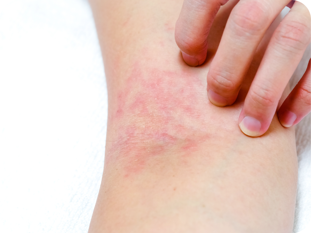 Et si c’était de <b>l’eczéma</b> ?